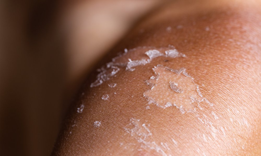 Natural moisturizers for dry skin relief, eczema, and other skin conditions, featuring ingredients like calendula and coconut oil.